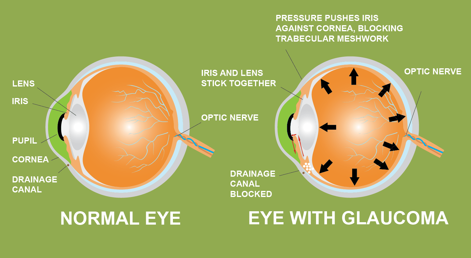 glaucoma iride cannabis canale allievo lente drenaggio cornea prevenzione