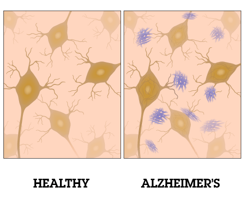 ALZHEIMER e MARIhUANA