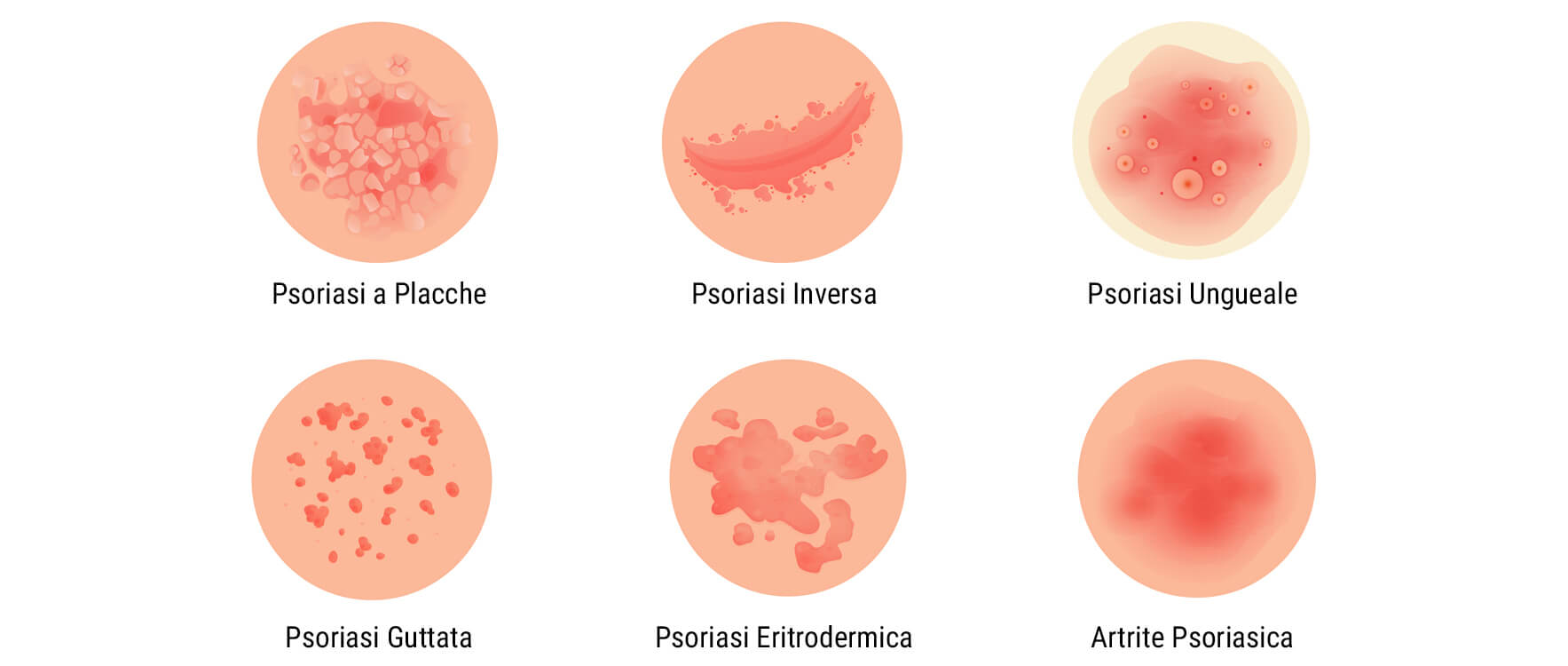 Cos'è la Psoriasi? Cos'è la Psoriasi?