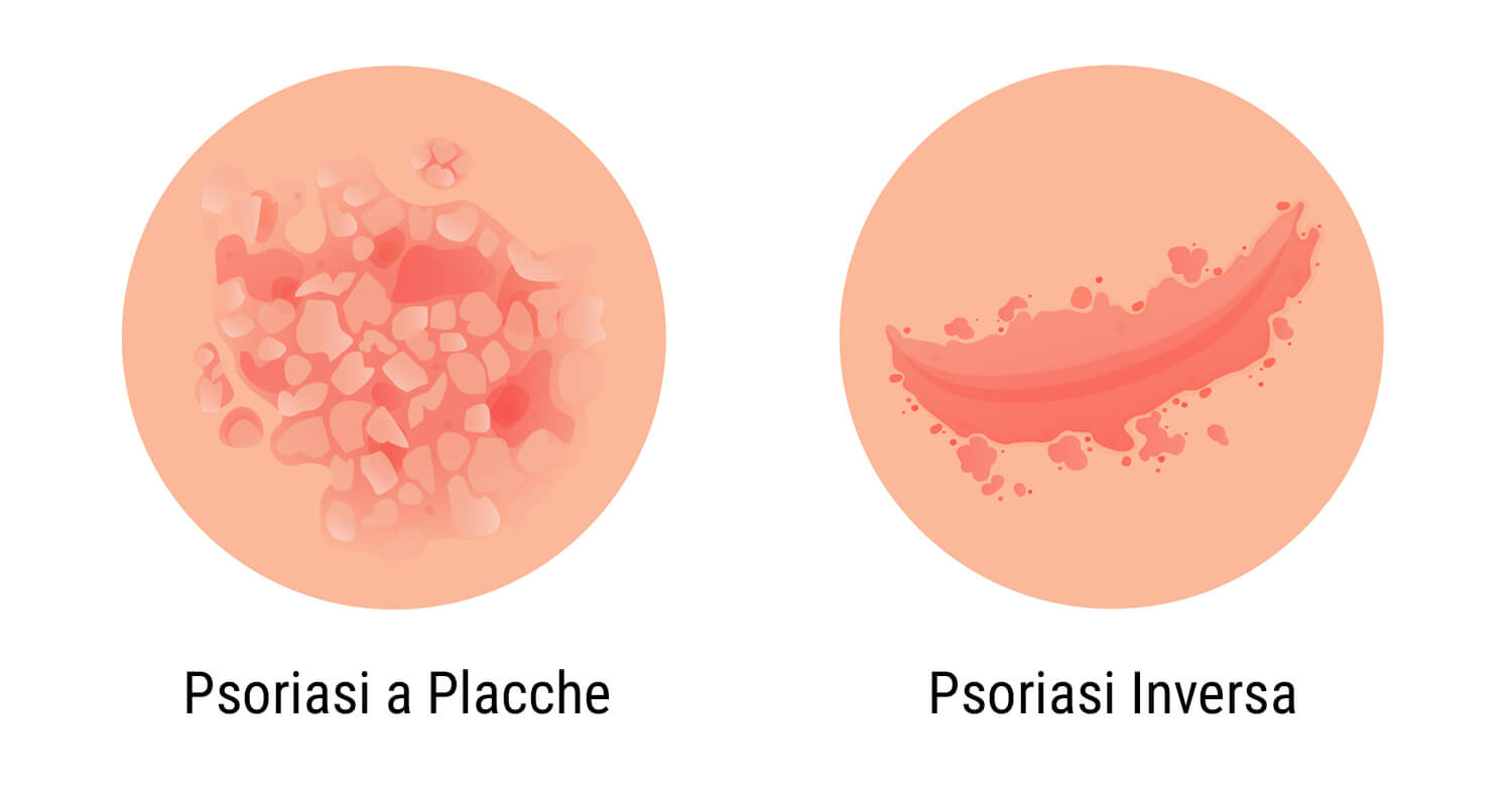 Cos'è la Psoriasi? Cos'è la Psoriasi?