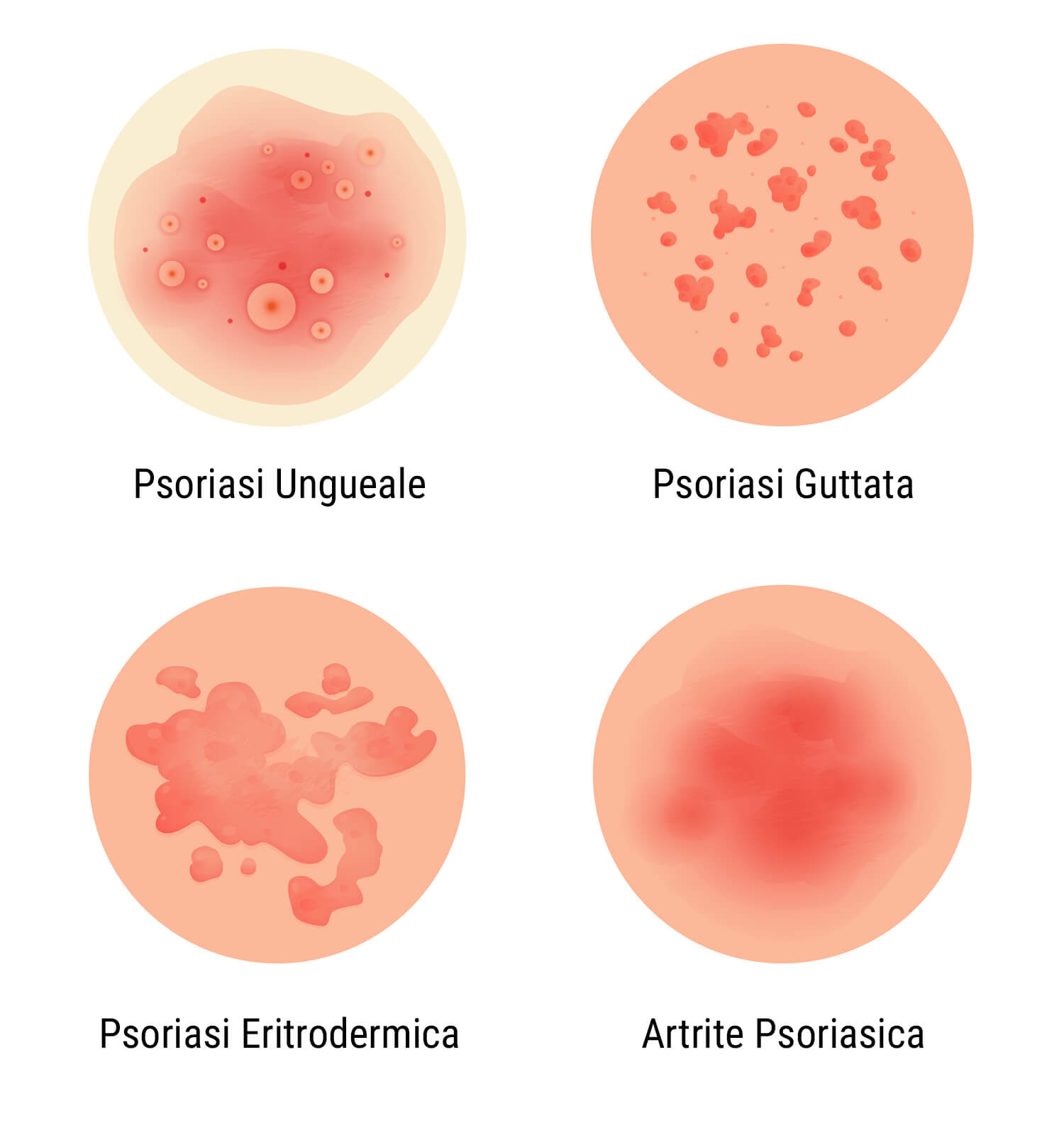 Cos'è la Psoriasi? Cos'è la Psoriasi?