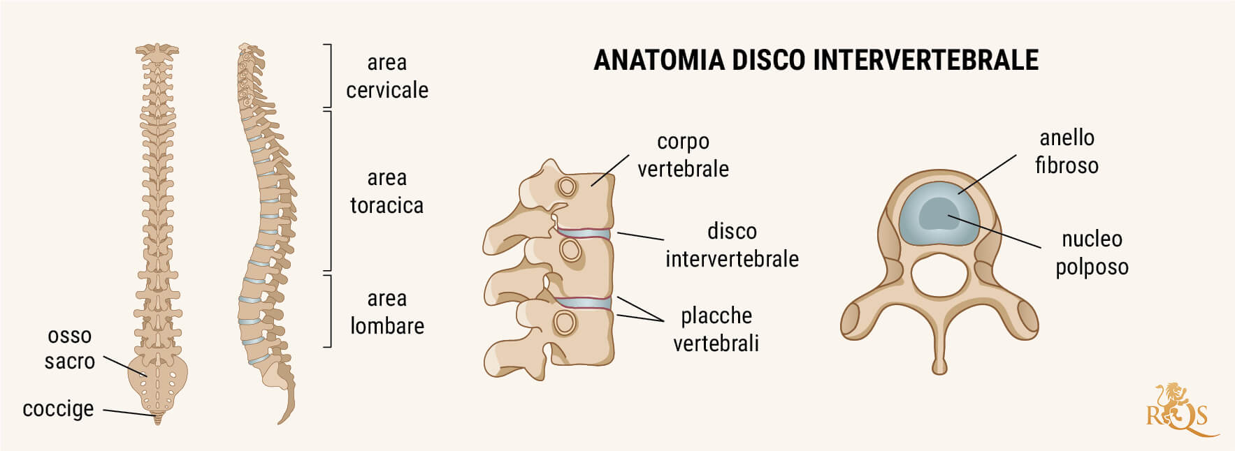 Cos'è la Malattia Degenerativa del Disco?