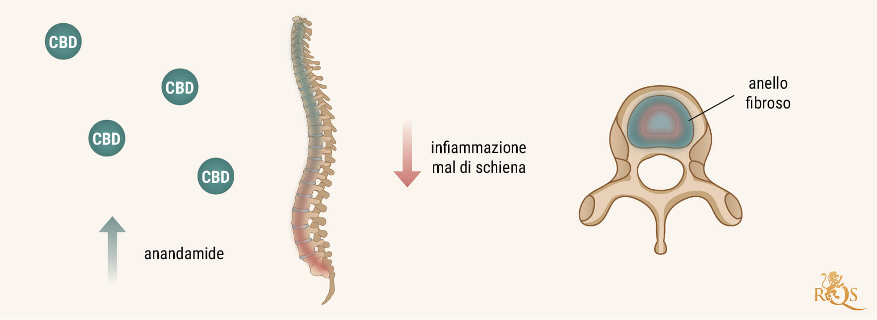 In Che Modo il CBD Può Essere Utile in Caso di Discopatia Degenerativa?