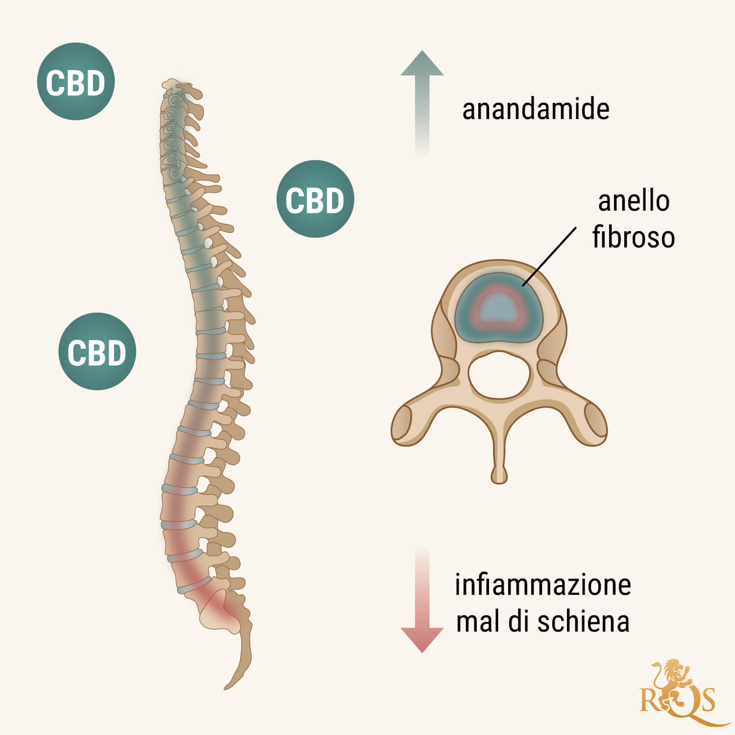 In Che Modo il CBD Può Essere Utile in Caso di Discopatia Degenerativa?