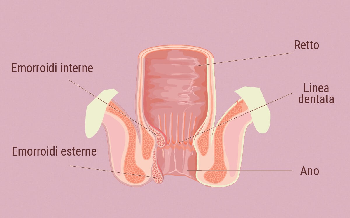 Il rapporto fra SEC ed emorroidi