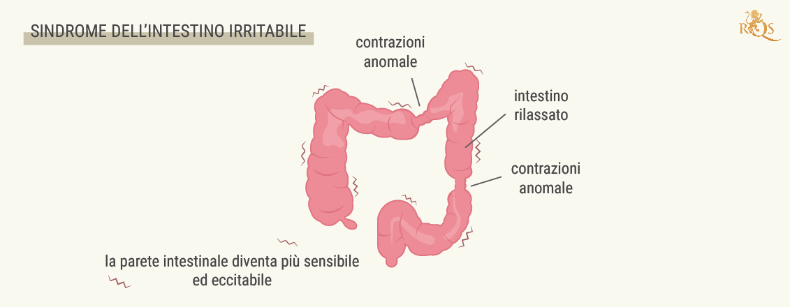 Cos’è la sindrome dell’intestino irritabile?