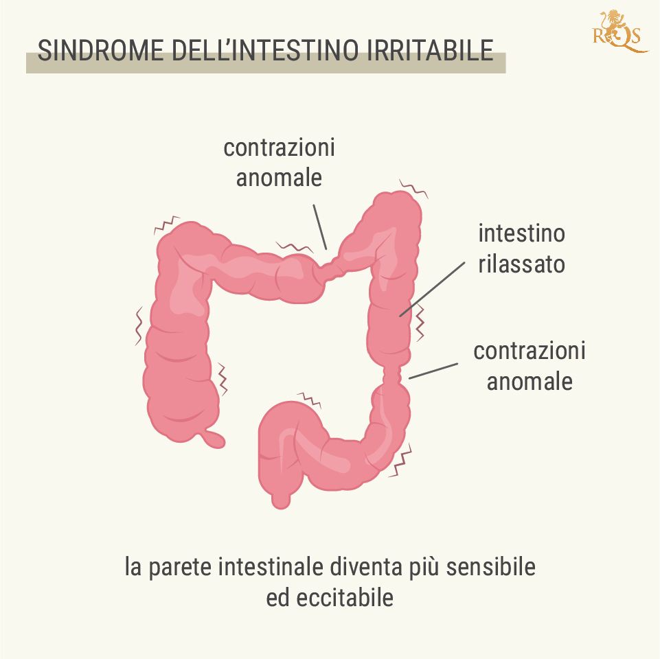 Cos’è la sindrome dell’intestino irritabile?