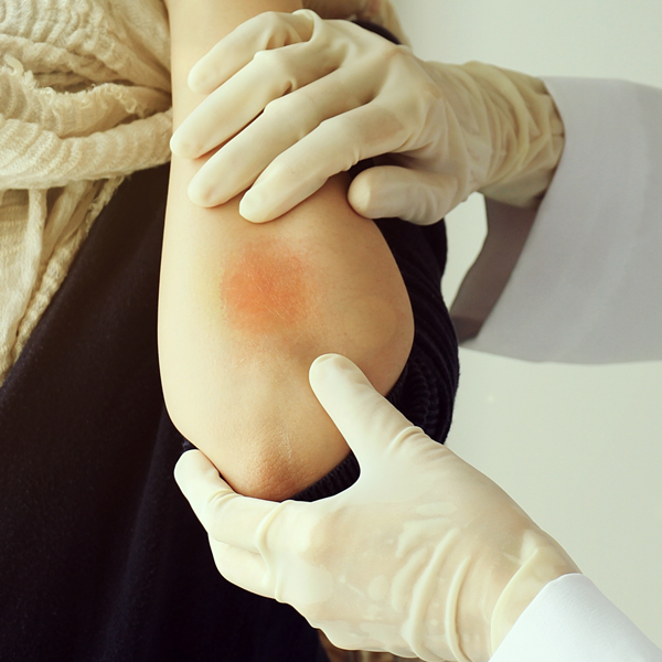 La psoriasi può esser trasmessa attraverso contatto sessuale