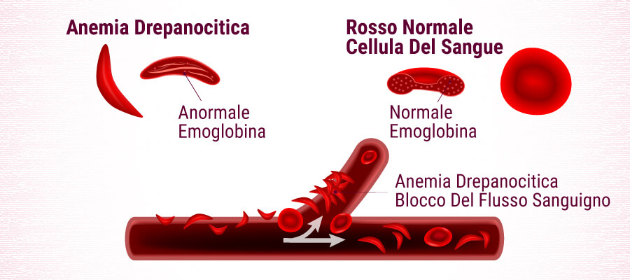 Anemia Falciforme Vs Normale Globulo Rosso Anemia Falciforme Vs Normale Globulo Rosso