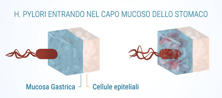 H Pylori Muco Strato Di Gastrite E Cannabis Gastrica H Pylori Muco Strato Di Gastrite E Cannabis Gastrica