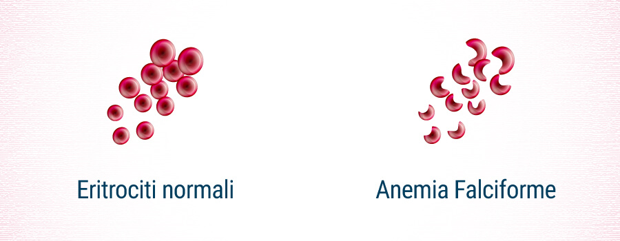 Anemia Falciforme Anemia Falciforme