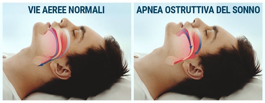 Apnea Ostruttiva Del Sonno