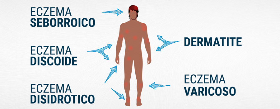 Tipi di eczema e il suo trattamento con la cannabis Tipi di eczema e il suo trattamento con la cannabis