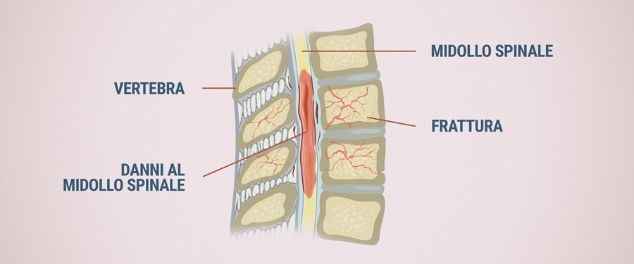 Danni Al Midollo Spinale