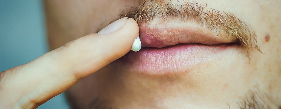 trattamento della cannabis per l'herpes trattamento della cannabis per l'herpes