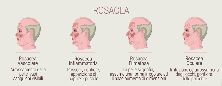 Rosacea Rosacea