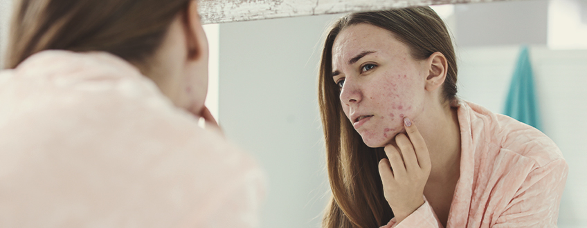 Come si forma l'acne Come si forma l'acne