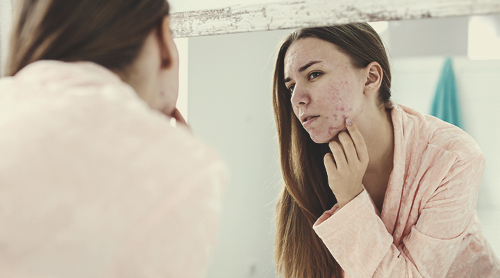 Come si forma l'acne Come si forma l'acne