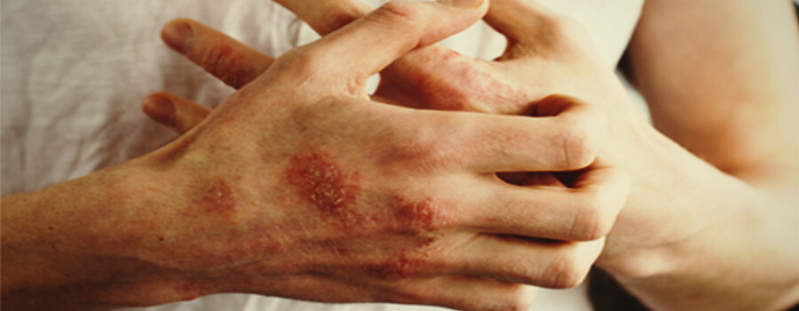 Eczema e allergie Eczema e allergie