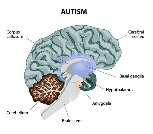 cannabis e autismo