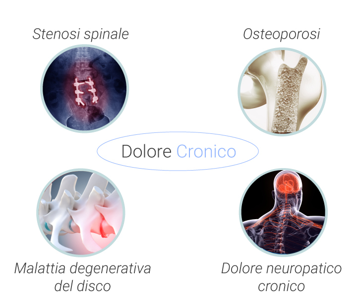 Cause frequenti e tipi di mal di schiena