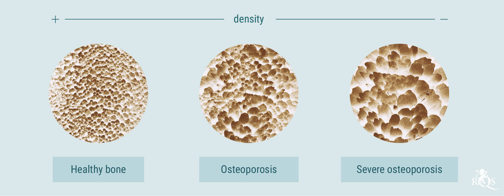 Cannabis e osteoporosi