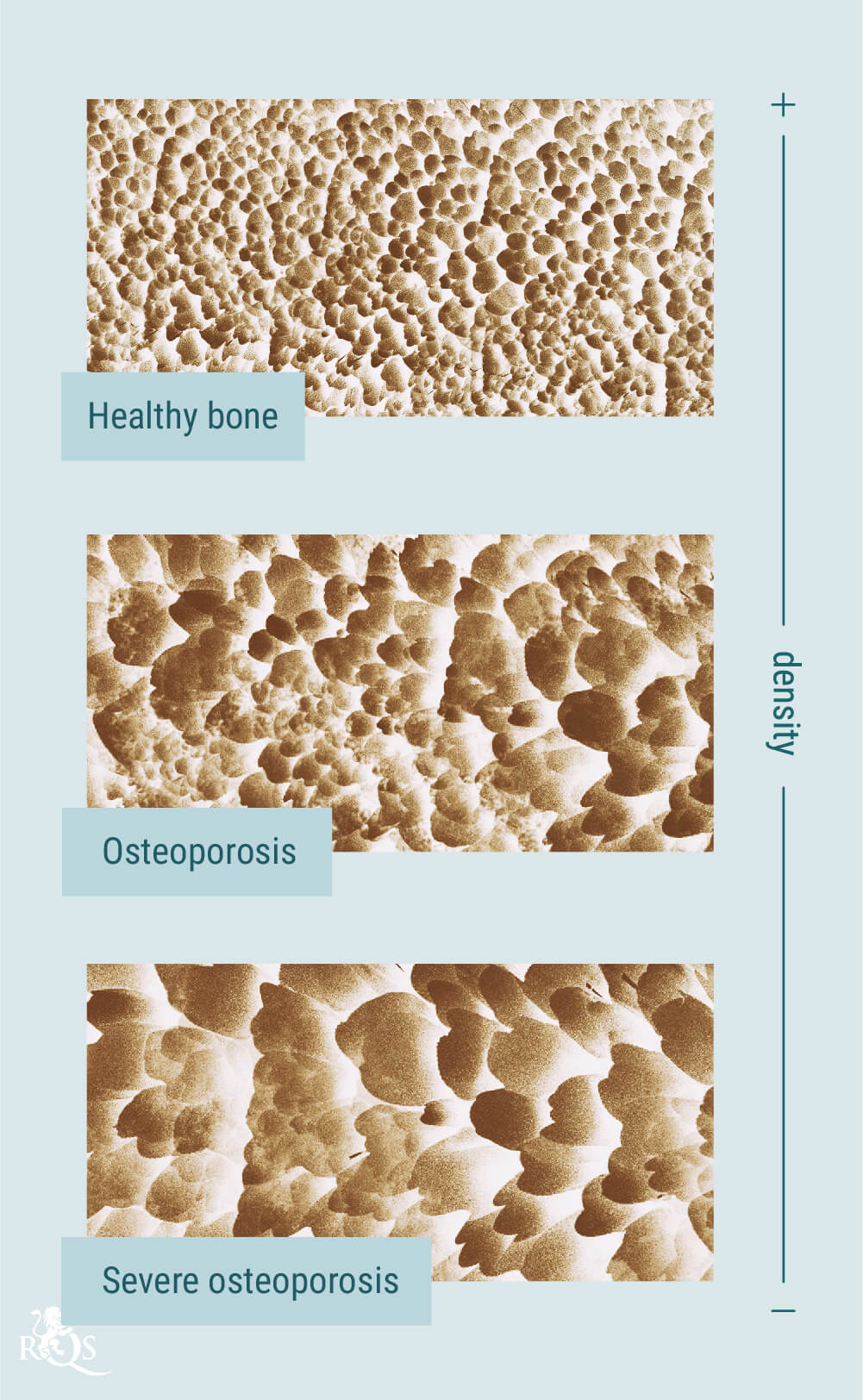 Cannabis e osteoporosi