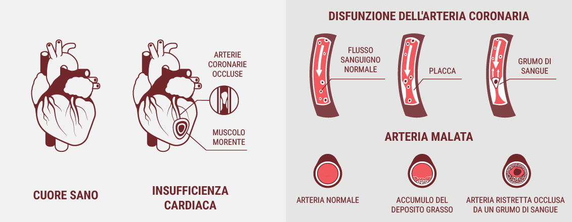 Le malattie cardiovascolari e le malattie cardiache sono la stessa cosa?