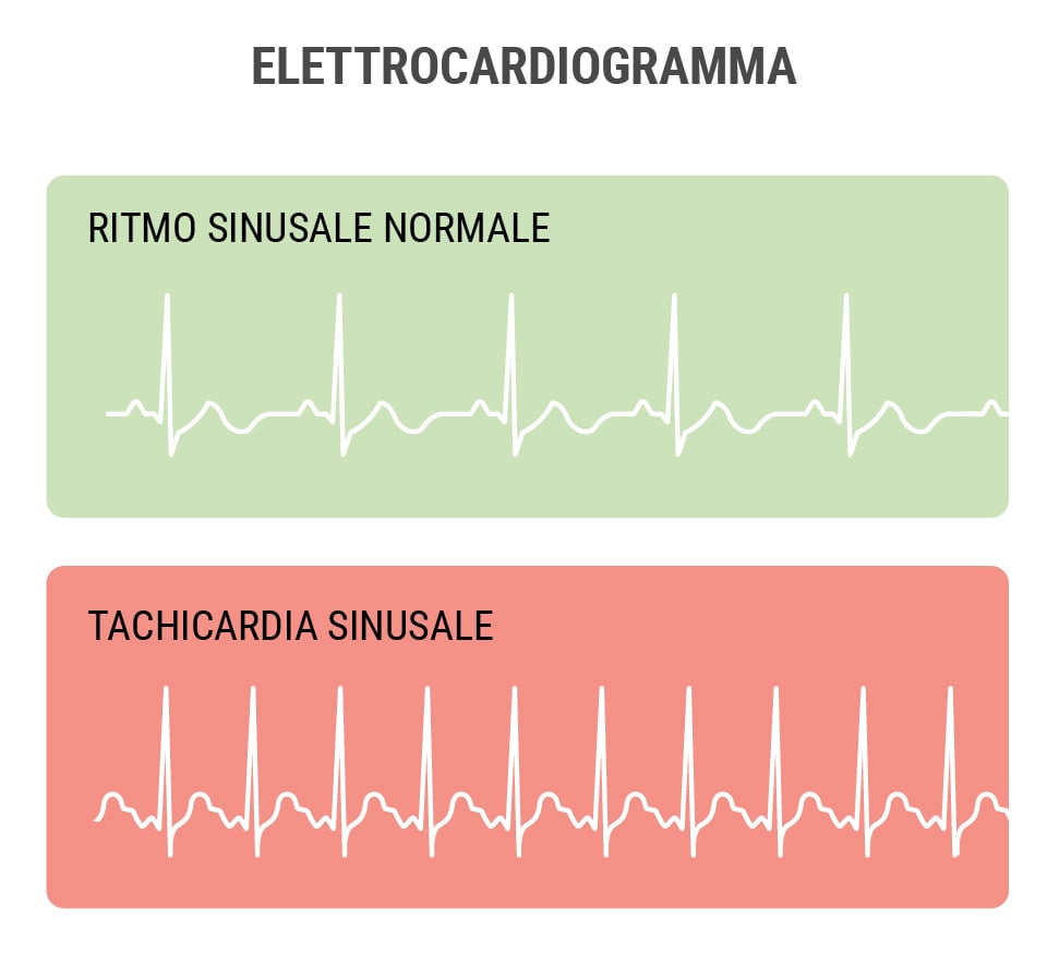 Perché la cannabis provoca un aumento del battito cardiaco?