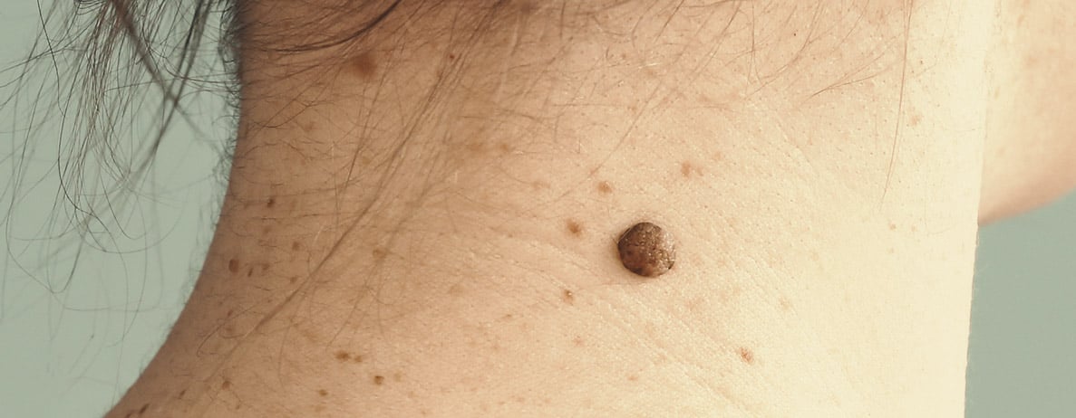 Sintomi del melanoma