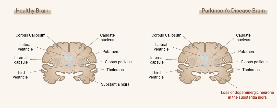Cos'è il morbo di Parkinson? Cos'è il morbo di Parkinson?