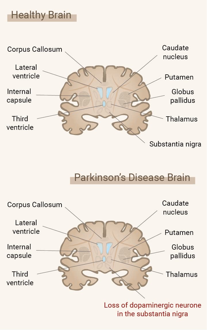 Cos'è il morbo di Parkinson? Cos'è il morbo di Parkinson?