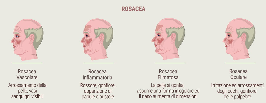 Cos'è la rosacea?