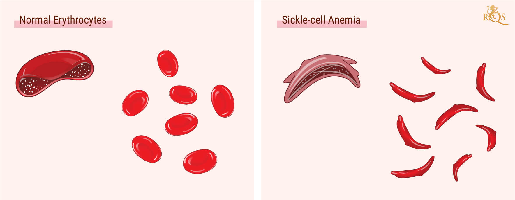 Cos’è l’anemia falciforme? Cos’è l’anemia falciforme?