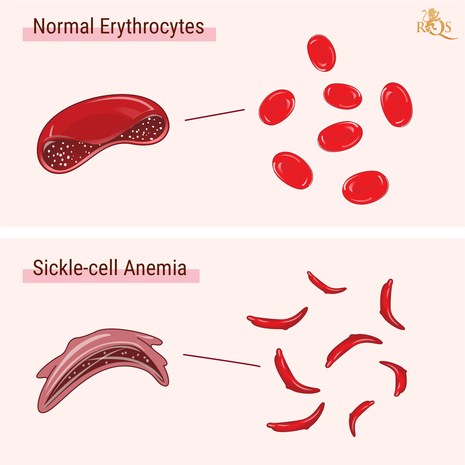 Cos’è l’anemia falciforme? Cos’è l’anemia falciforme?