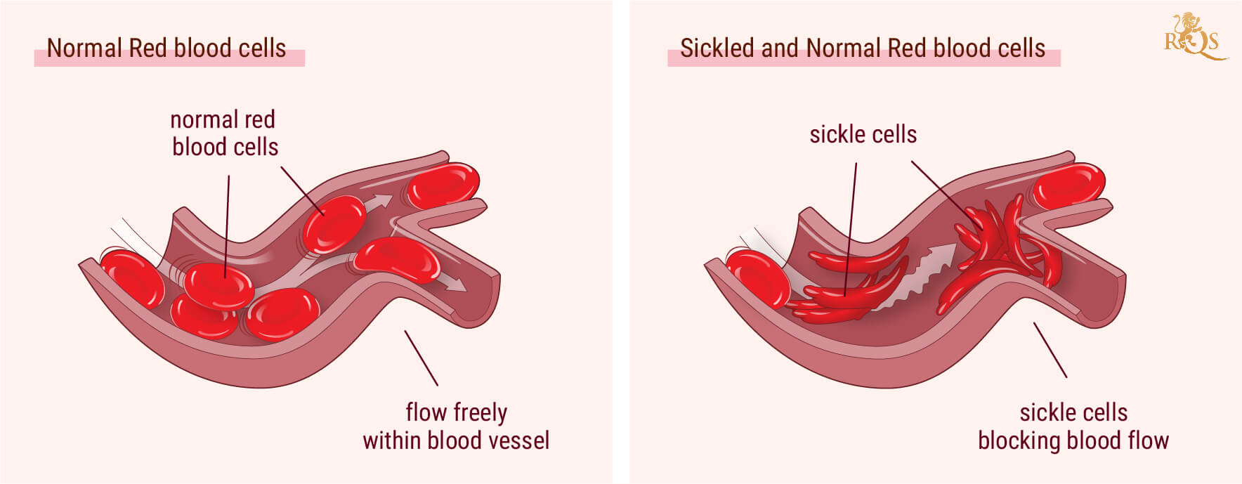 Cannabis e sintomi dell’anemia falciforme Cannabis e sintomi dell’anemia falciforme
