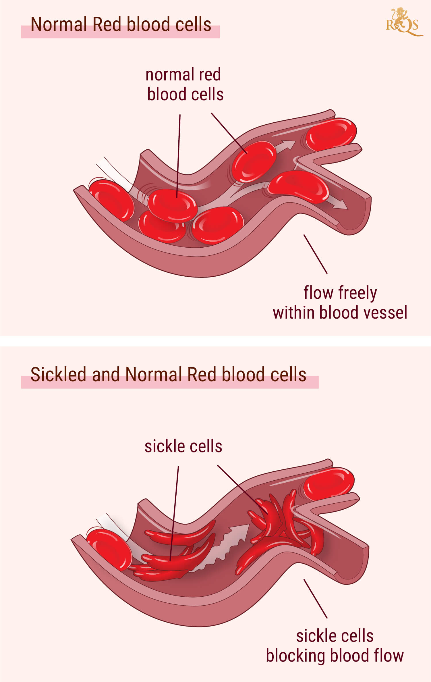 Cannabis e sintomi dell’anemia falciforme Cannabis e sintomi dell’anemia falciforme