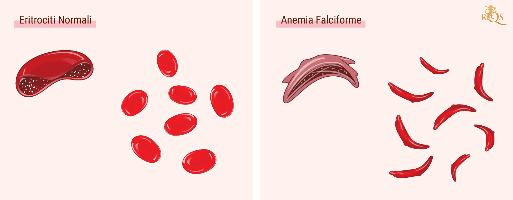 Cos’è l’anemia falciforme?