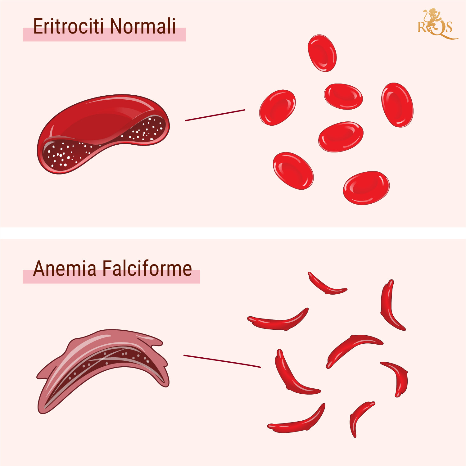 Cos’è l’anemia falciforme?
