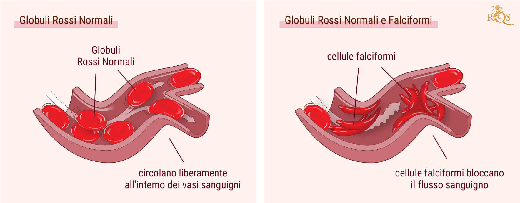 Cannabis e sintomi dell’anemia falciforme