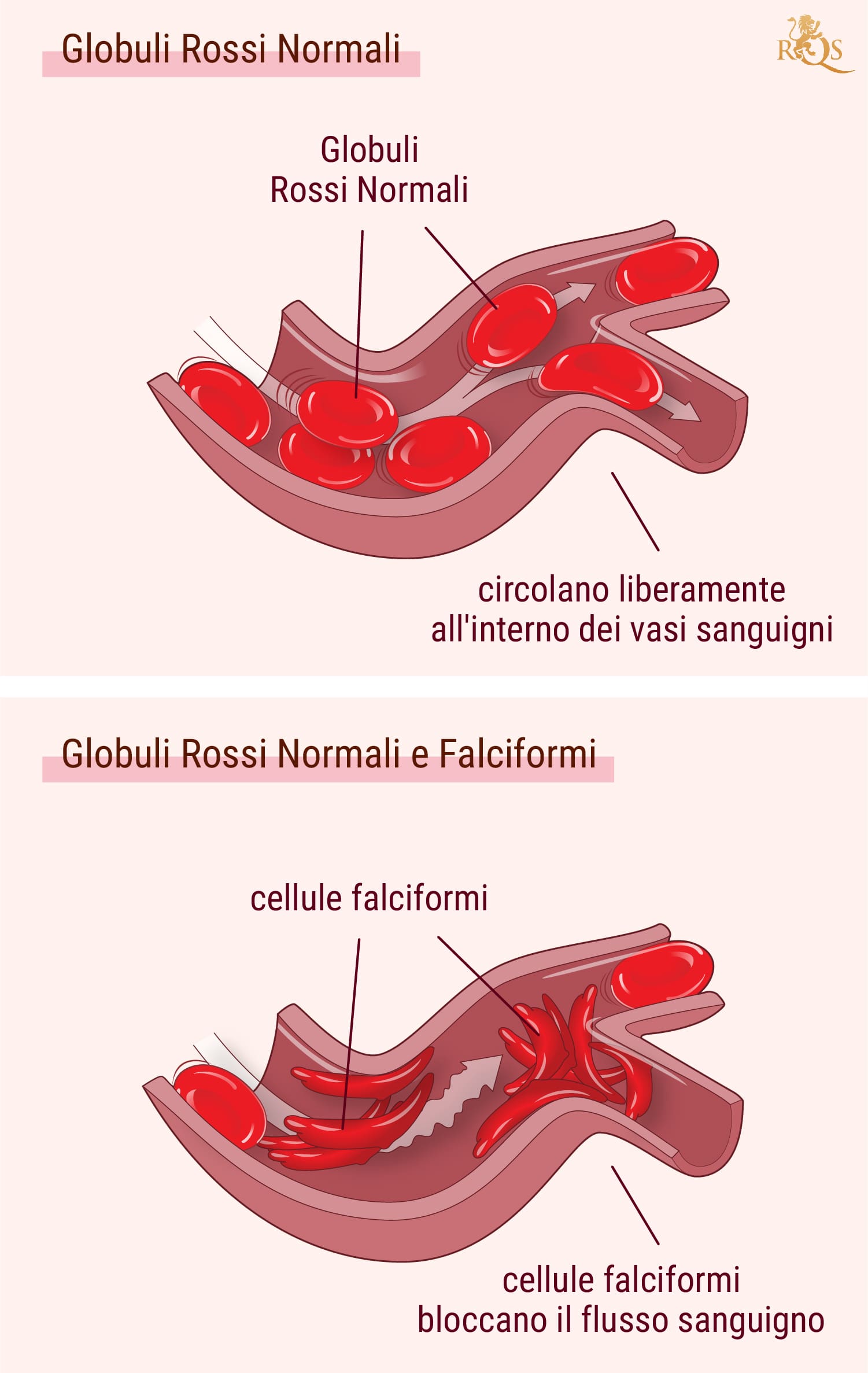 Cannabis e sintomi dell’anemia falciforme