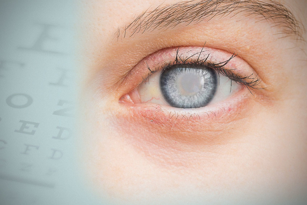 Cannabis e glaucoma: Tutto quello che c’è da sapere