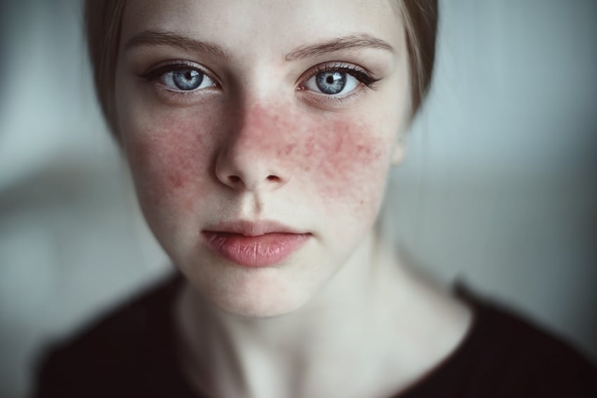 Tutte le informazioni su cannabis e lupus